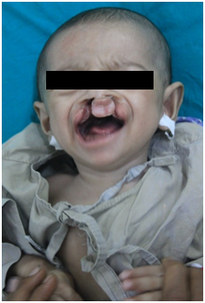 Cleft surgery for poor child