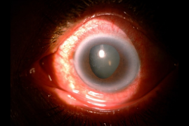 Retina Glaucoma patient