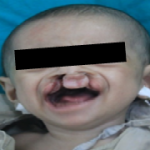 Cleft surgery for poor child