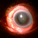 Retina Glaucoma patient